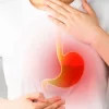 Hyper acidity in ayurveda